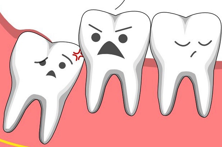 Biến chứng sau khi nhổ răng khôn có thể bạn chưa biết