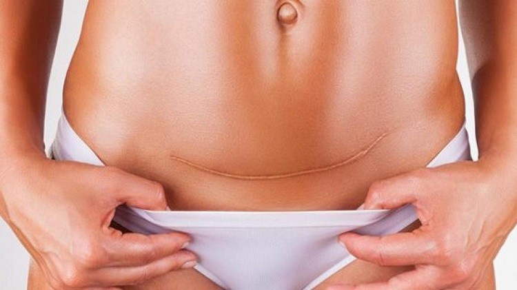 Hé lộ bí quyết đối phó với sẹo mổ đẻ cực hiệu quả cho mẹ sau sinh