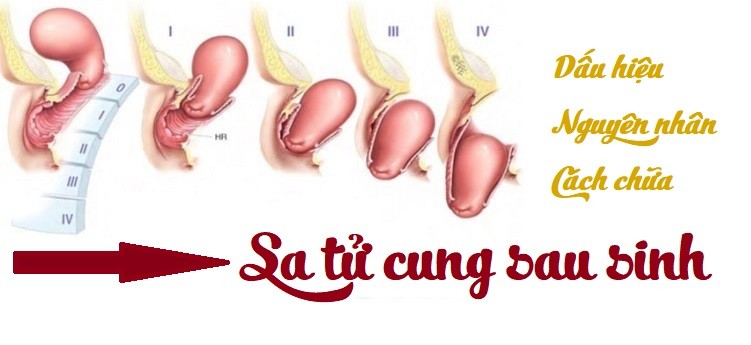 Dấu hiệu sa tử cung sau sinh, nguyên nhân do đâu