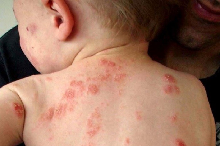 Bệnh chốc lở ở trẻ em là gì