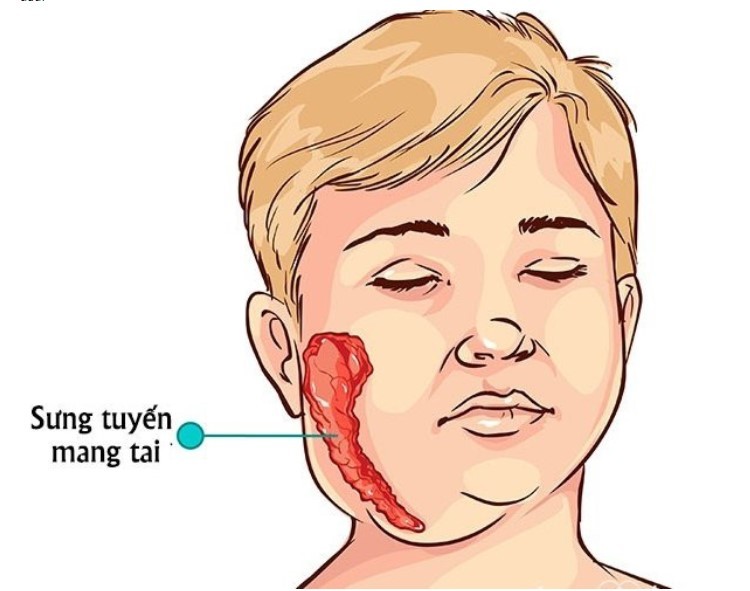 Bệnh quai bị ở trẻ nhỏ và những điều cần chú ý
