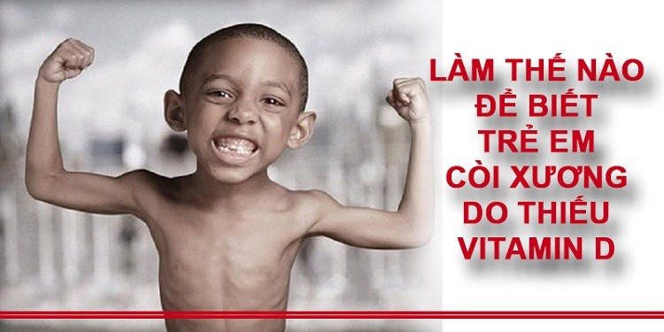 Vì sao thiếu vitamin D trẻ bị còi xương