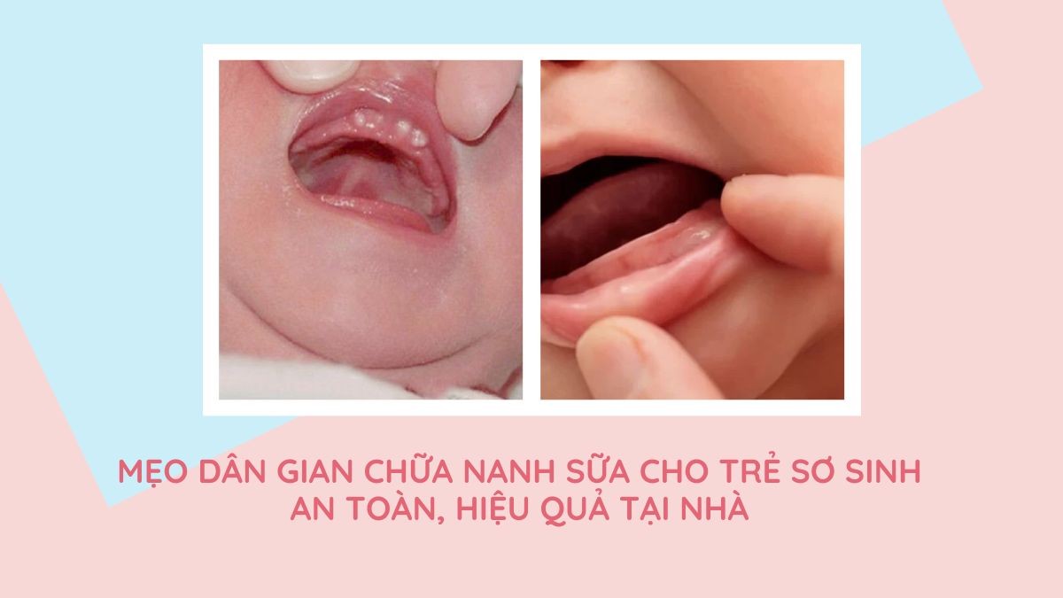Mẹo dân gian chữa nanh sữa cho trẻ sơ sinh an toàn, hiệu quả tại nhà