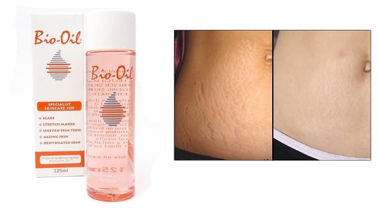 trị rạn da Bio-Oil