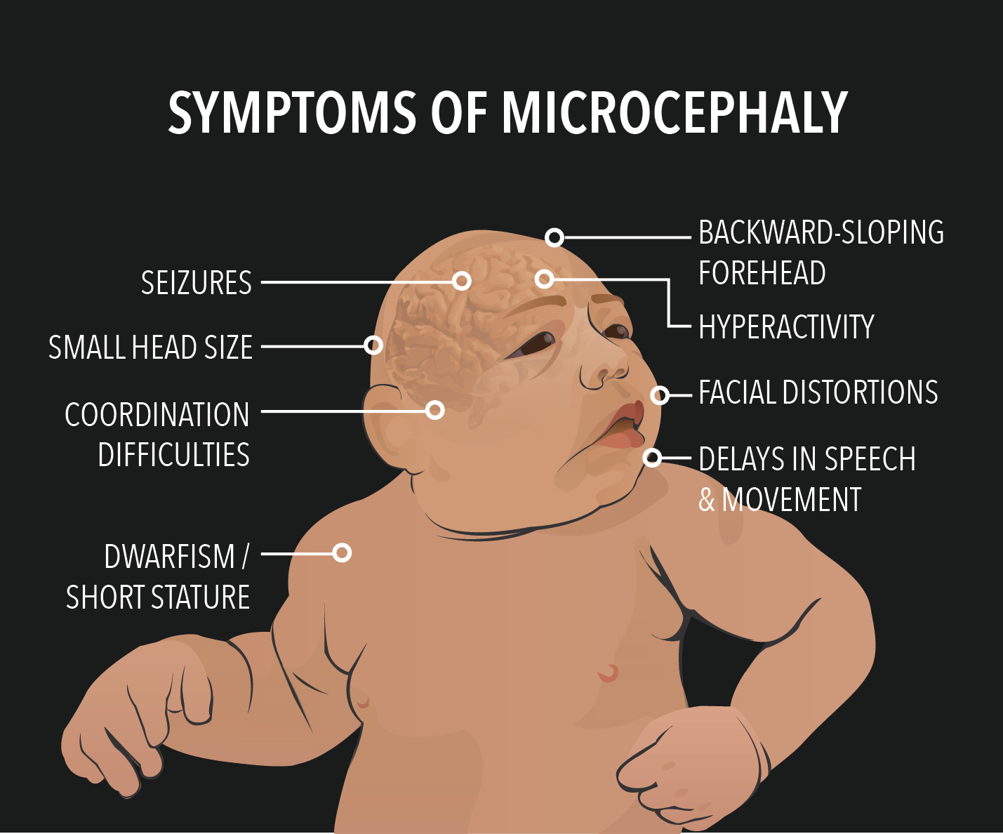 virus zika là gì