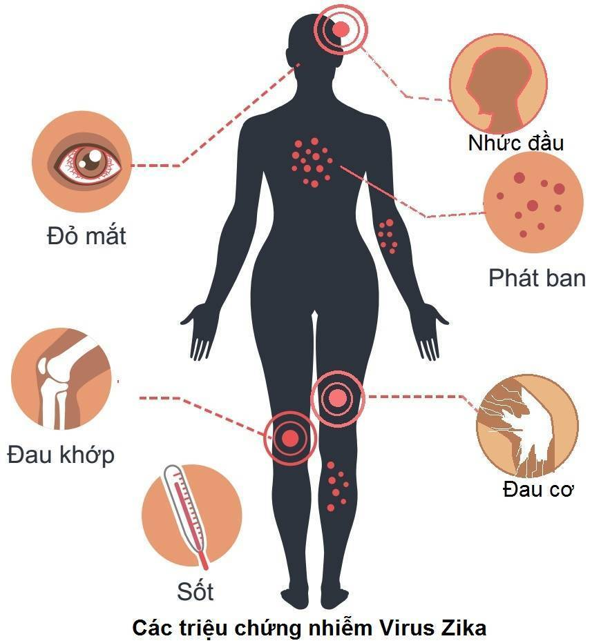 virus zika là gì