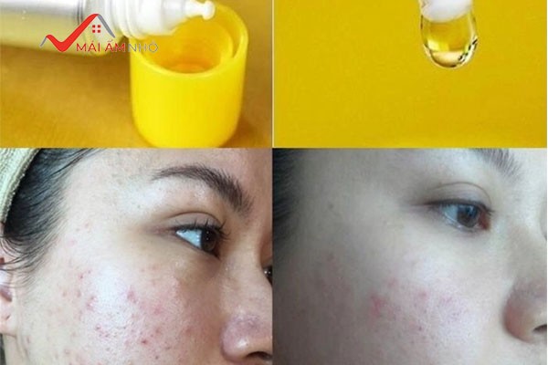 Mẹ bầu có thể sử dụng serum CC Melano