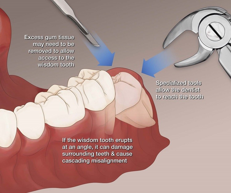 địa chỉ nhổ răng khôn uy tín tại hà nội