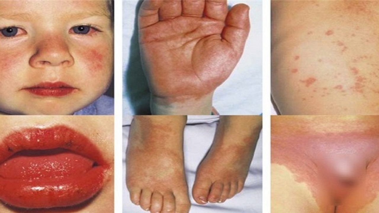 Kawasaki bệnh, bệnh Kawasaki là gì, bệnh Kawasaki là bệnh gì, chi phí chữa bệnh Kawasaki, bệnh Kawasaki ở trẻ em, bệnh Kawasaki 2019, bệnh Kawasaki có lây không, bệnh Kawasaki có nguy hiểm không, bệnh Kawasaki trẻ em, bệnh sốt Kawasaki, bệnh Kawasaki bệnh học, dấu hiệu bệnh Kawasaki, kinh nghiệm điều trị bệnh Kawasaki, bệnh Kawasaki điều trị, bệnh Kawasaki nguyên nhân, bệnh Kawasaki ở việt nam, phác đồ điều trị bệnh Kawasaki, biểu hiện bệnh Kawasaki, nguyên nhân gây bệnh Kawasaki, cách điều trị bệnh Kawasaki, bệnh Kawasaki ở trẻ, bệnh lý Kawasaki, bệnh Kawasaki co lay nhiem khong, bệnh tim Kawasaki, bệnh Kawasaki 2018, bệnh Kawasaki 2017, bệnh Kawasaki có tái phát không, bệnh Kawasaki slide, bệnh Kawasaki có khỏi được không, bệnh Kawasaki biến chứng, phòng bệnh Kawasaki, bệnh Kawasaki có lây ko, các bệnh Kawasaki, bệnh Kawasaki có lây, bệnh Kawasaki dịch tễ, dịch bệnh Kawasaki, bệnh Kawasaki không điển hình, bệnh Kawasaki có chữa được không, Kawasaki bệnh gì, Kawasaki bệnh học, bệnh hiếm Kawasaki, bệnh lạ Kawasaki, bệnh viêm mạch máu Kawasaki, viêm mạch máu Kawasaki, chăm sóc bệnh nhân Kawasaki, bệnh Kawasaki ở trẻ nhỏ, điều trị bệnh Kawasaki ở trẻ em, bệnh Kawasaki tái phát, bệnh Kawasaki slideshare