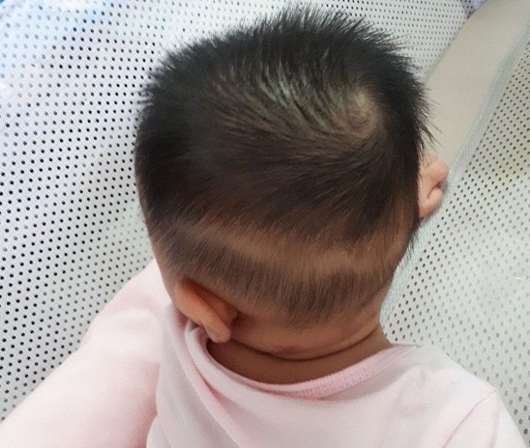 Rụng tóc vành khăn là gì trẻ bị rụng tóc vành khăn, rụng tóc vành khăn ở trẻ sơ sinh, rụng tóc hình vành khăn, rụng tóc vành khăn ở trẻ nhỏ, rụng tóc vành khăn ở trẻ, rụng tóc vành khăn là gì, bé rụng tóc vành khăn, rụng tóc vành khăn ở trẻ em, trẻ bị rụng tóc vành khăn nên uống gì