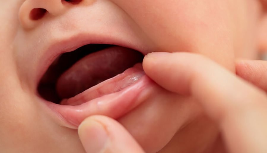 bé chậm mọc răng, bé chậm mọc răng nên ăn gì, vì sao trẻ chậm mọc răng, nguyên nhân trẻ chậm mọc răng, trẻ chậm mọc răng nên bổ sung gì, trẻ chậm mọc răng có sao không, bé chậm mọc răng phải làm sao, bé chậm mọc răng có sao không, tại sao trẻ chậm mọc răng, vì sao bé chậm mọc răng, trẻ chậm mọc răng phải làm sao