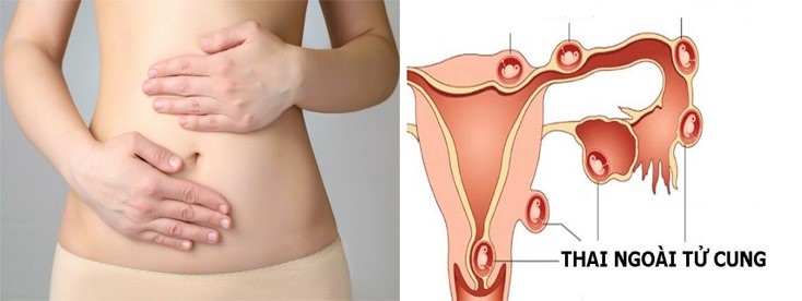 có thai ngoài tử cung thử que được không, có thai ngoài tử cung thử que biết không, mang thai ngoài tử cung có kinh nguyệt không