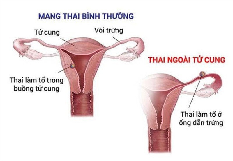 Mang thai ngoài tử cung là gì? Nguyên nhân, dấu hiệu mang thai ngoài tử cung là gì, mang thai ngoài tử cung có dấu hiệu gì, có thai ngoài tử cung phải làm sao, mang thai ngoài tử cung có nguy hiểm không, mang thai ngoài tử cung dấu hiệu, mang thai ngoài tử cung có giữ được không, tại sao mang thai ngoài tử cung, mang thai ngoài tử cung có sao không, mang thai ngoài tử cung có kinh không, mang thai ngoài tử cung có biểu hiện gì
